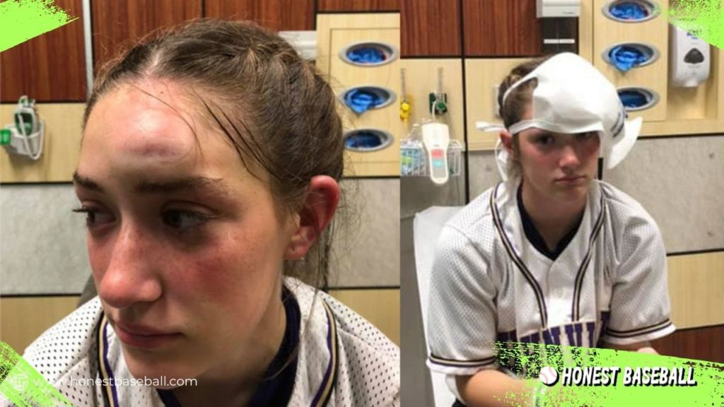 In 2019, softball player Laney Waguespack was injured due to not wearing a pitching mask